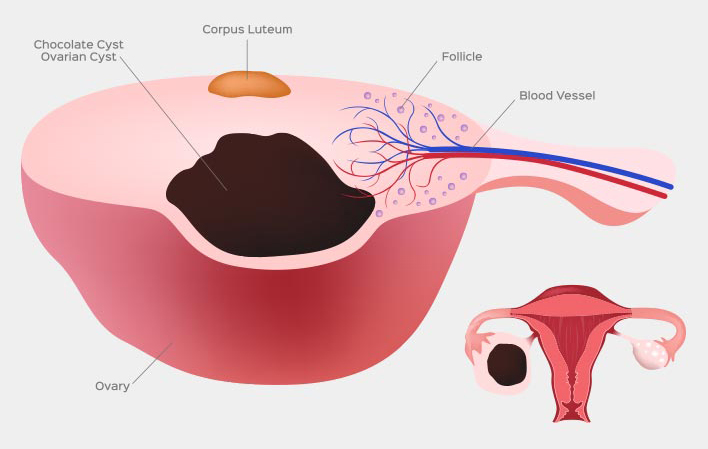 chocolate cyst specialist in Ahmedabad
