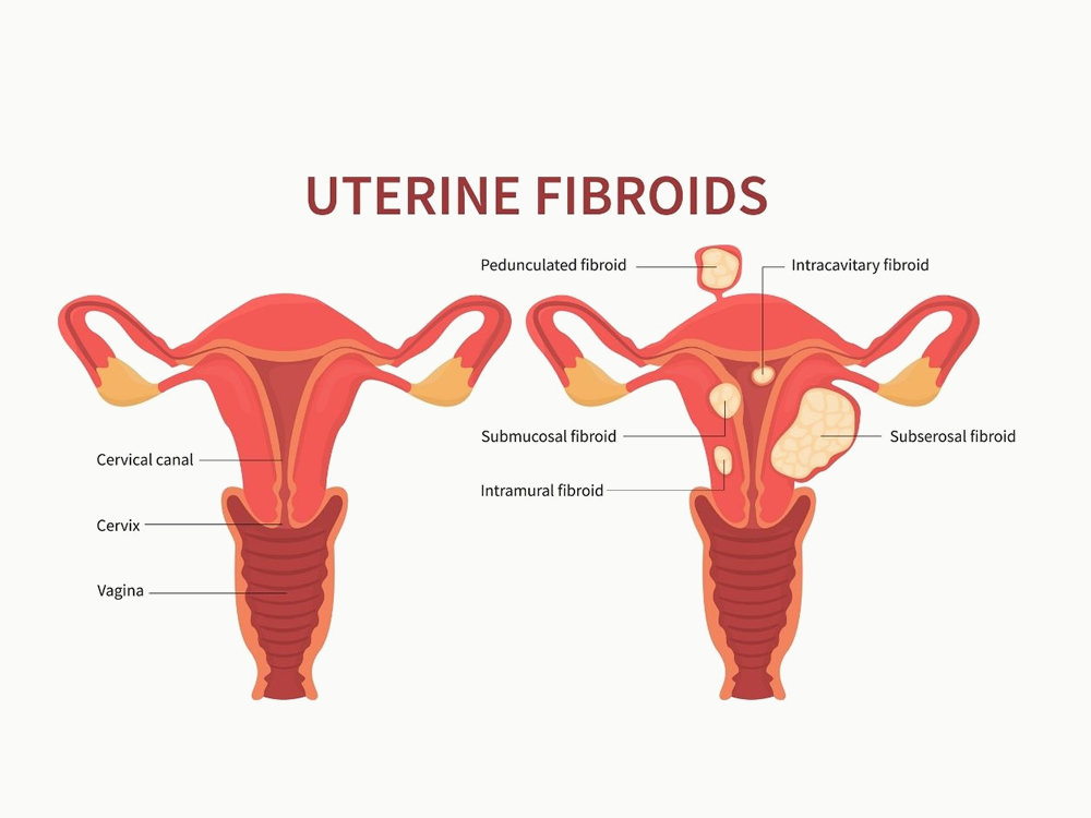 uterine fibroid doctor in Ahmedabad