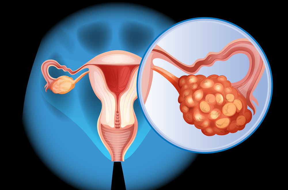 ovarian cancer treatment in Ahmedabad