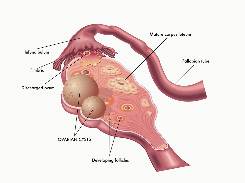 ovarian cyst surgery in Ahmedabad