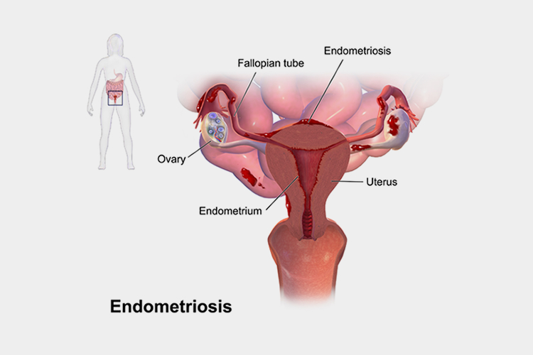 endometriosis excision